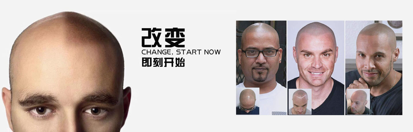 哈尔滨星点纹发